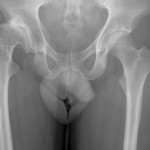 Osteoarthritis due to hip dysplasia Osteoarthritis due to hip dysplasia