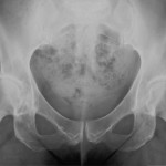 X-ray showing osteoarthritis of the right hip X-ray showing osteoarthritis of the right hip