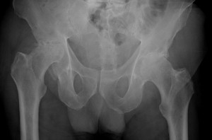 X-ray showing osteoarthritis of both hips and femoral head collapse (right) X-ray showing osteoarthritis of both hips and femoral head collapse (right)